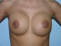 breast-augmentation-after-10