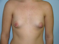 breast-augmentation-before-8