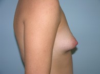 breast-augmentation-before-9