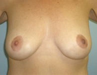 breast_augmentation2_after