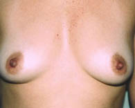 breastaug3_b