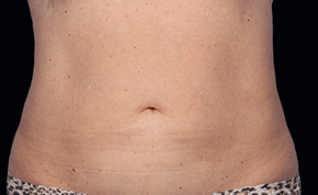 coolsculpting-miami-female-patient-2-after