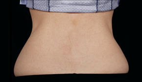 coolsculpting-miami-female-patient-back-after