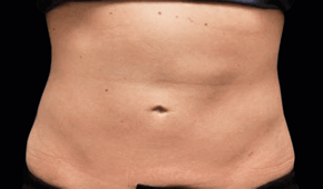 coolsculpting-miami-male-after