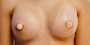 breast-augmentation-12b-300x150