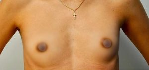 breast-augmentation-13a-300x142