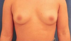 breast-augmentation-15a-1-300x174