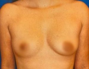 breast-augmentation-16a-300x234