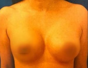 breast-augmentation-16b-300x232