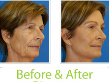 before-after-facelift