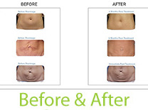 Who Is The Right Candidate To Have Cool Sculpting Before And After In Miami