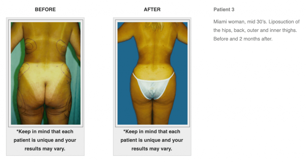Dr-Salomon-Liposuction-Before-After-Image-5-1024x547