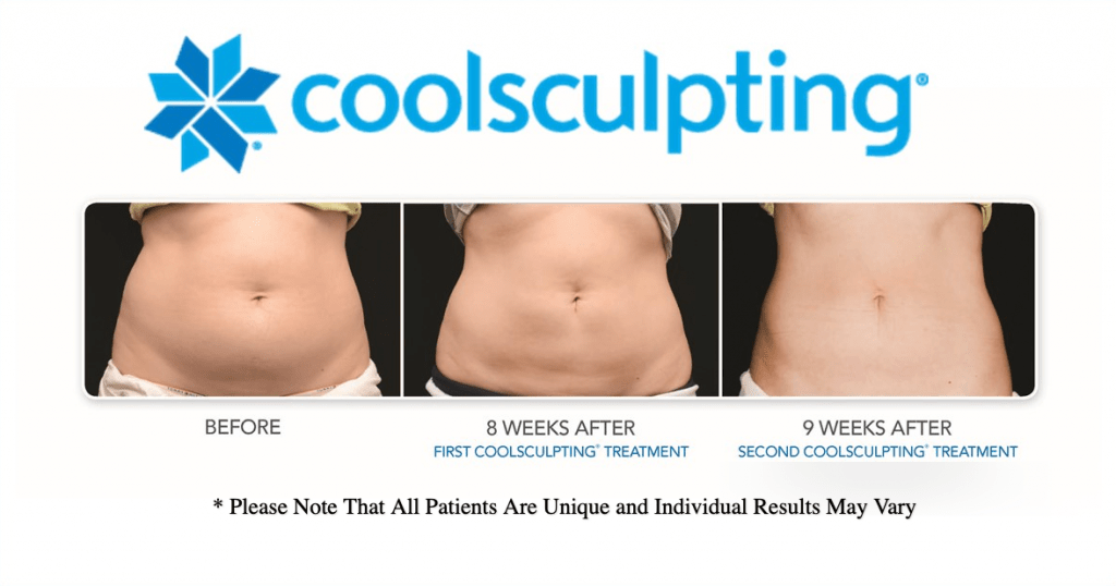 Dr.-Salomon-CoolSculpting-Results-after-8-and-9-weeks-1024x538