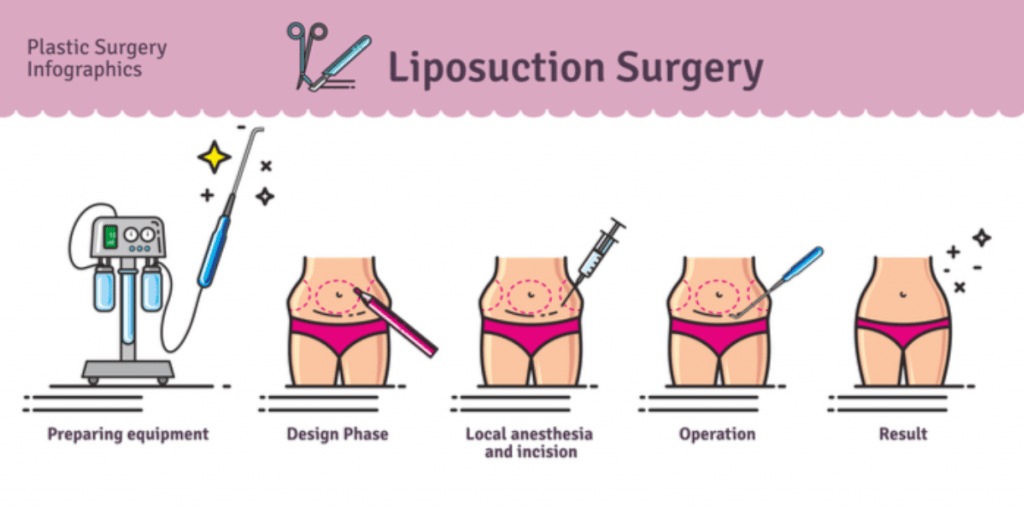 Dr.-Salomon-Liposuction-Infographic-1024x509