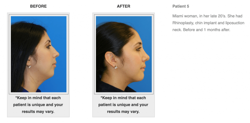 Dr.-Salomon-Neck-Lift-Before-and-After-Image-8-1024x503