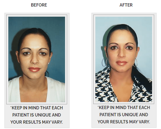 before and after eyelid surgery